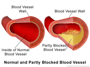 Blocked-Artery